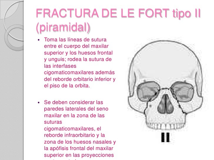 lefort fracturas